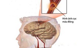 Thuốc làm tiêu cục máu đông trong nhồi máu não